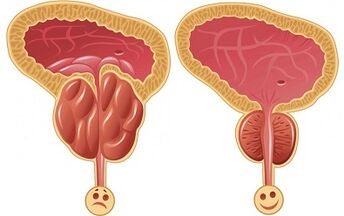 kumaha ProstEro prostatitis jalan sateuacan sareng saatos perlakuan