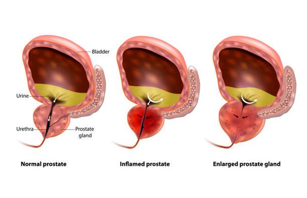 prostatitis mangrupikeun peradangan kelenjar prostat