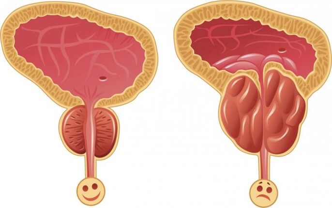 prostat séhat sareng radang ku prostatitis