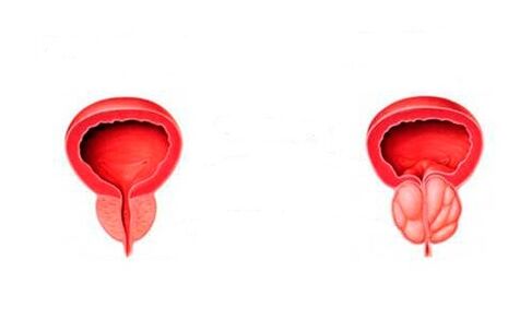prostat séhat sareng radang ku prostatitis