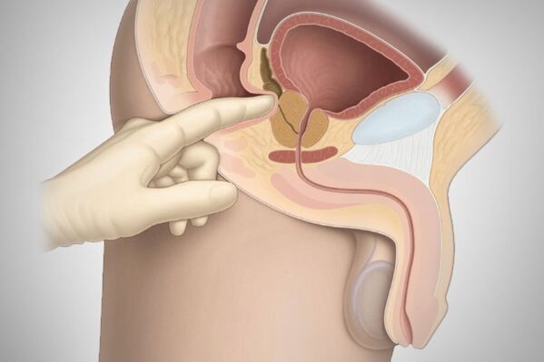 Pijat prostat pikeun prostatitis baktéri