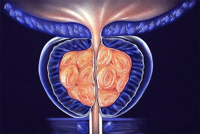 gejala jeung perlakuan prostatitis