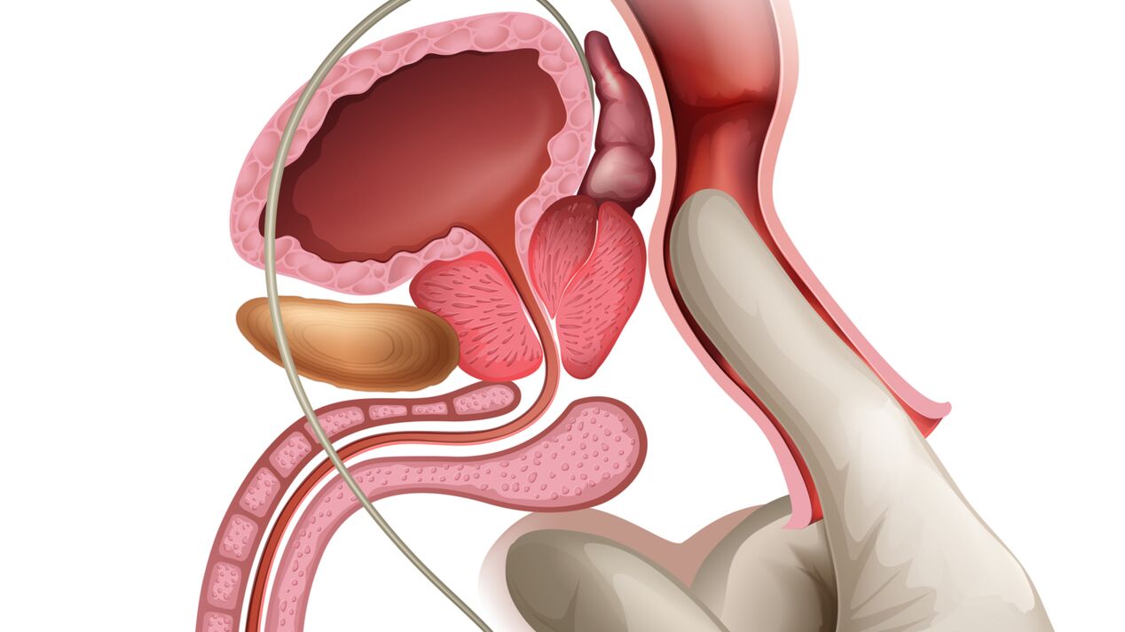 Urut prostat mangrupakeun cara éféktif pikeun ngubaran prostatitis congestive