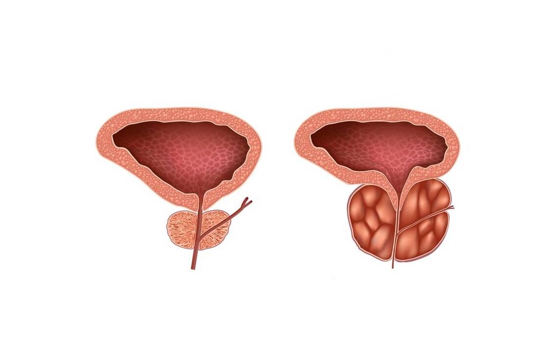 Gejala prostatitis di lalaki