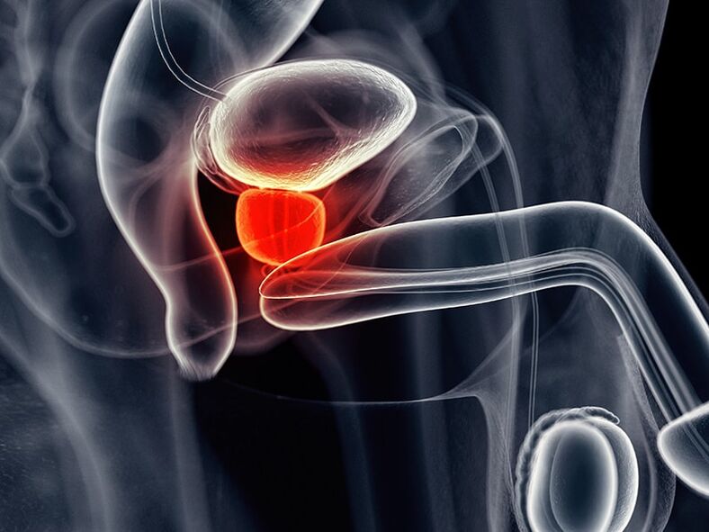 Peradangan kelenjar prostat anu dibarengan ku prostatitis kronis